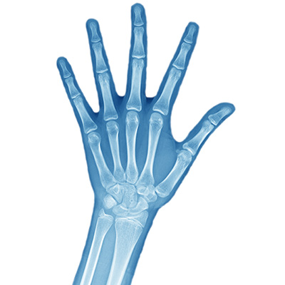 Hand and upper extremity xray