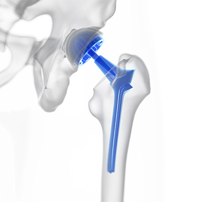 Total joint replacement