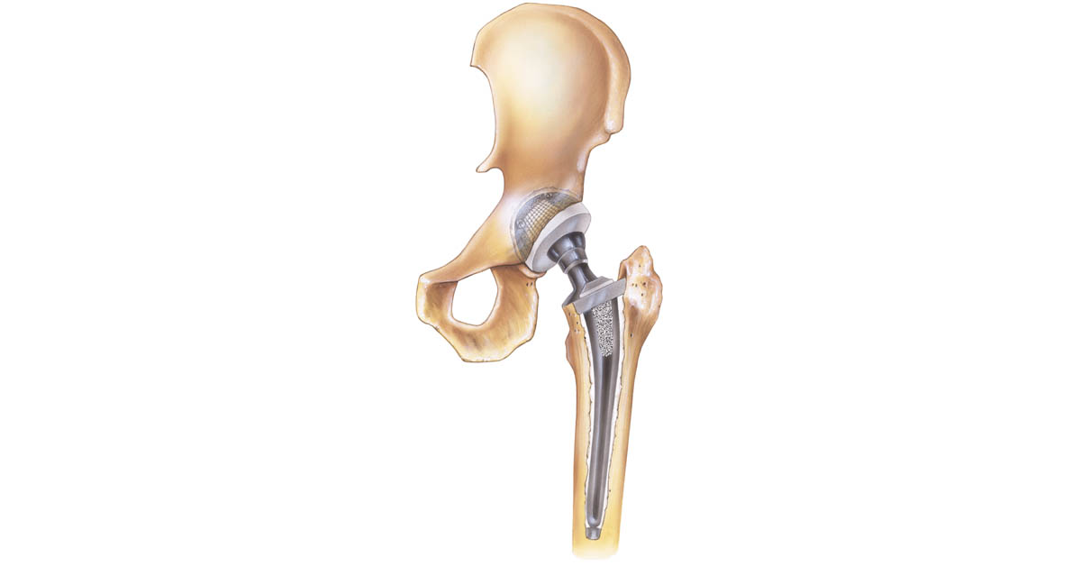 Hip replacement diagram